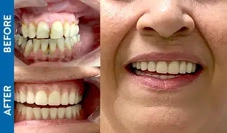 Nelda W. Before and After Dental Implants